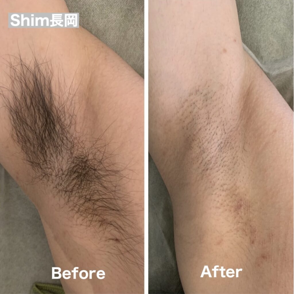 脇 脱毛 メンズ